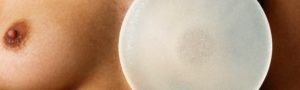 Chirurgie esthétique des seins à Lyon - L'aréole - Dr Corniglion