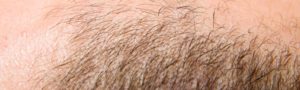 Greffe de cheveux à Lyon - Dr Corniglion
