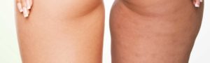 Lifting des cuisses à Lyon - Dr Corniglion, chirurgien esthétique