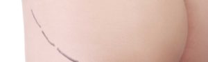 Lipoaspiration ou liposuccion à Lyon - Dr Corniglion