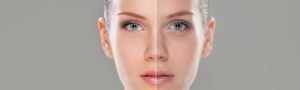 Peeling du visage à Lyon - Dr Corniglion