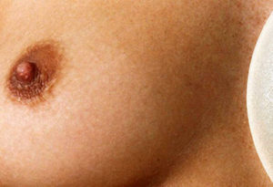 Chirurgie esthétique des seins à Lyon - L'aréole - Dr Corniglion