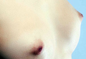 Chirurgie esthétique des seins à Lyon - Mamelon invaginé - Dr Corniglion