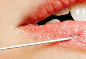 Injection d'acide hyaluronique pour les lèvres à Lyon - Dr Corniglion