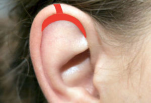 Les lobes d'oreille - Dr Corniglion, chirurgien esthétique à Lyon