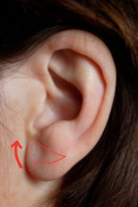 Les lobes d'oreille - Dr Corniglion, chirurgien esthétique à Lyon