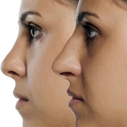 La rhinoplastie