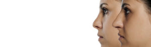 Chirurgie esthétique du nez ou rhinoplastie à Lyon - Dr Corniglion