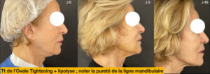 Laser K-bluelaserlift à Lyon chez le dr Corniglion